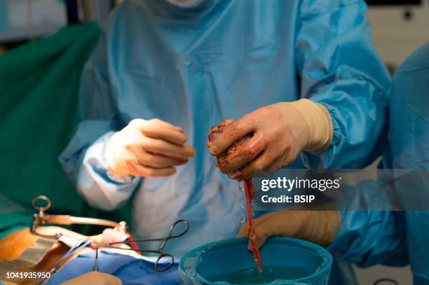 Kidney transplant in the urology, Nice, France, kidney is taken from a living related donor, the recipient's wife Transplanting the kidney in the...