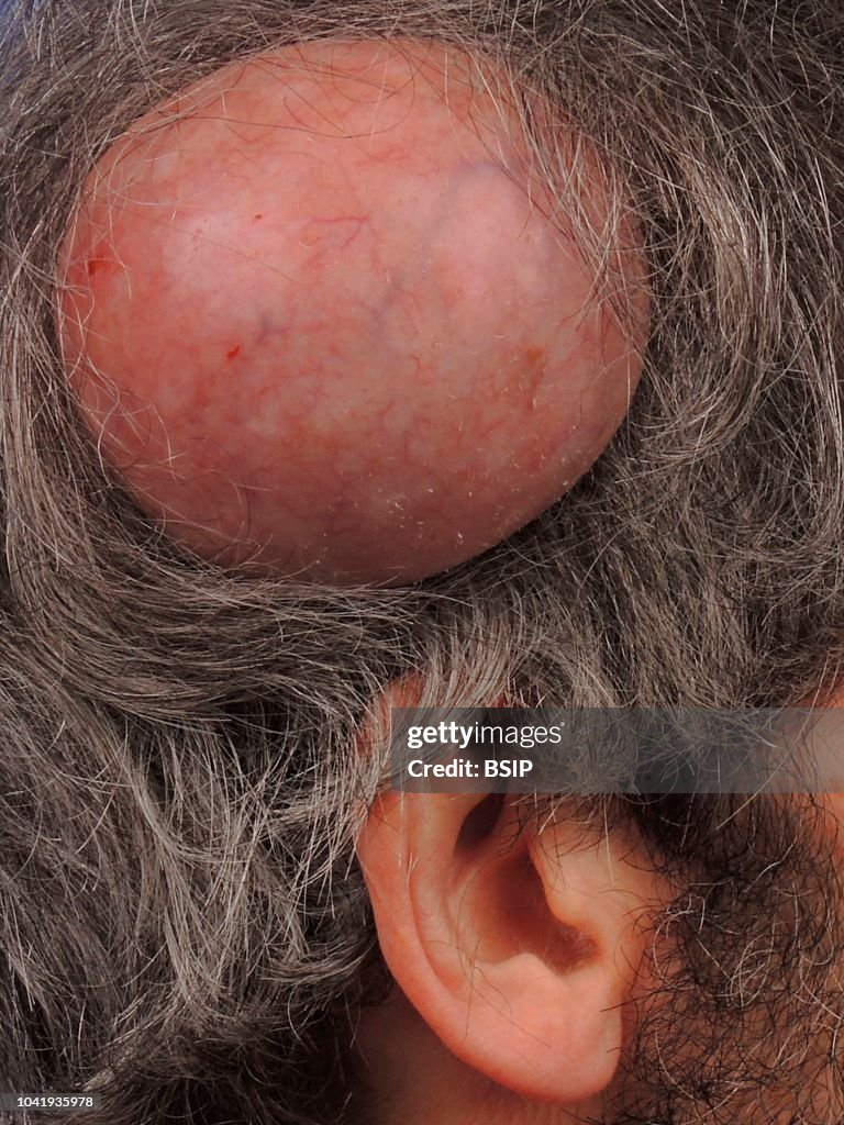 PILAR CYST