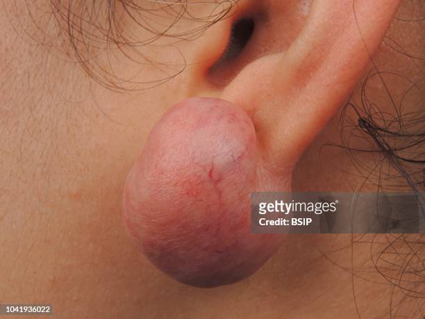Keloid of the earlobe.
