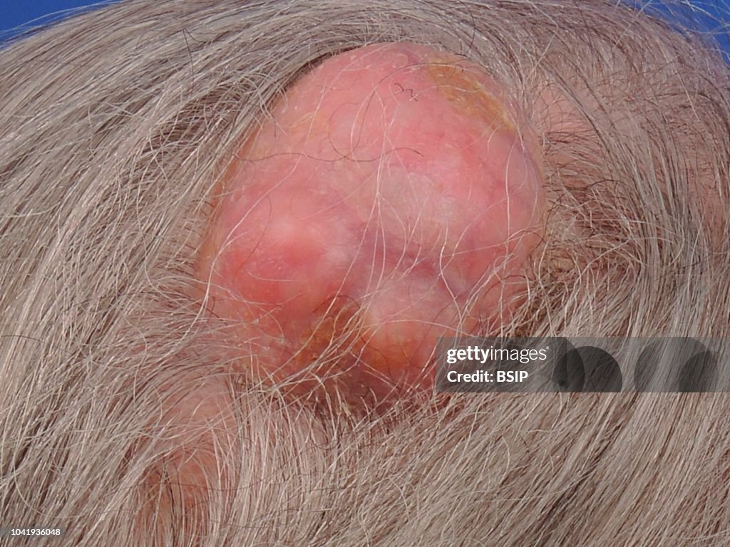 PILAR CYST