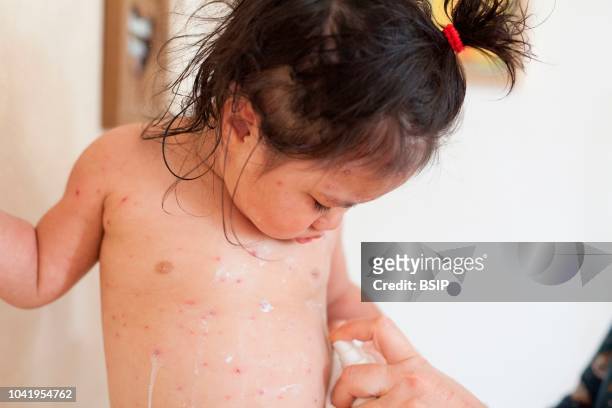 Month old girl with chicken pox Treatment with drying lotion.
