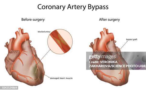 stockillustraties, clipart, cartoons en iconen met coronary artery bypass, illustration - coronary arteries diagram