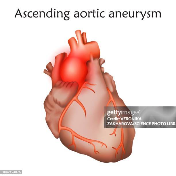 ilustrações de stock, clip art, desenhos animados e ícones de ascending aortic aneurysm, illustration - aorta