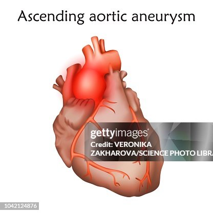Ascending Aortic Aneurysm Illustration High-Res Vector Graphic - Getty ...