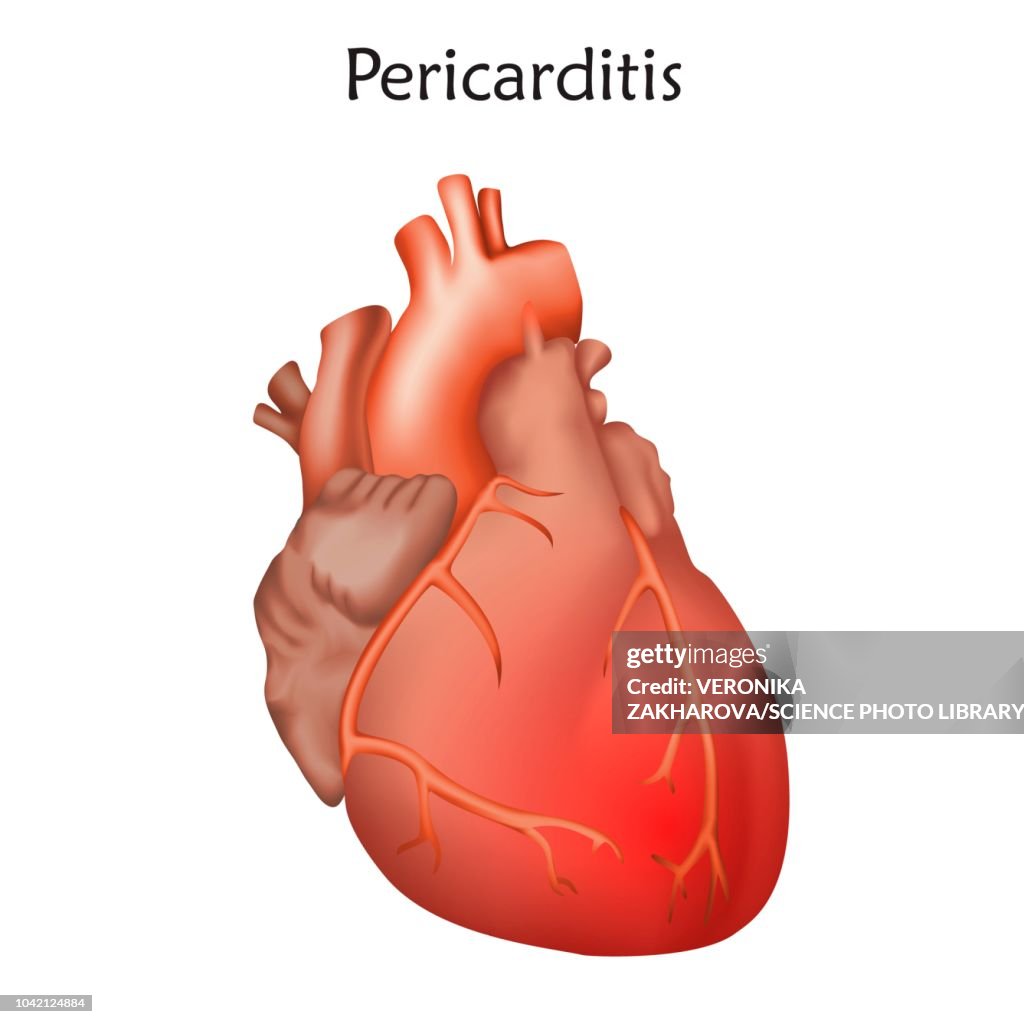 Pericarditis, illustration