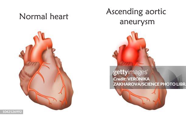 ascending aortic aneurysm, illustration - aortic aneurysm stock illustrations
