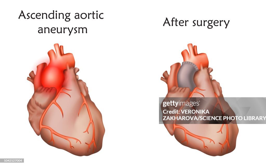 Ascending aortic aneurysm treatment, illustration