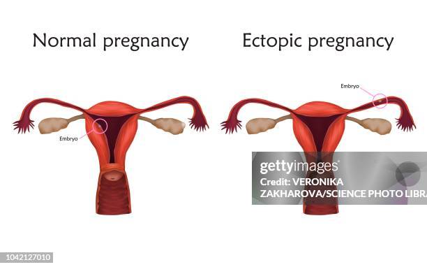 bildbanksillustrationer, clip art samt tecknat material och ikoner med ectopic pregnancy, illustration - äggledare