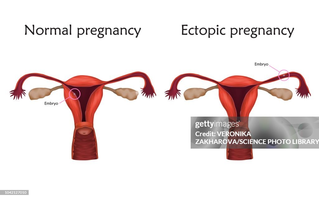 Ectopic pregnancy, illustration