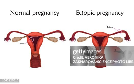 Ectopic pregnancy, illustration Ectopic pregnancy, illustration