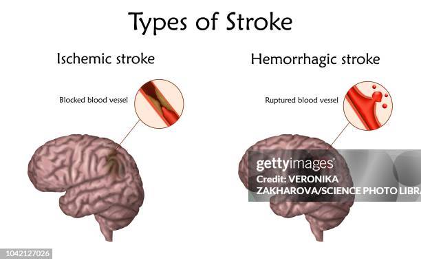 stroke types, illustration - ischemia stock illustrations