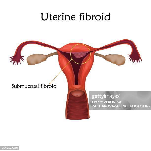 bildbanksillustrationer, clip art samt tecknat material och ikoner med uterine fibroid, illustration - äggledare