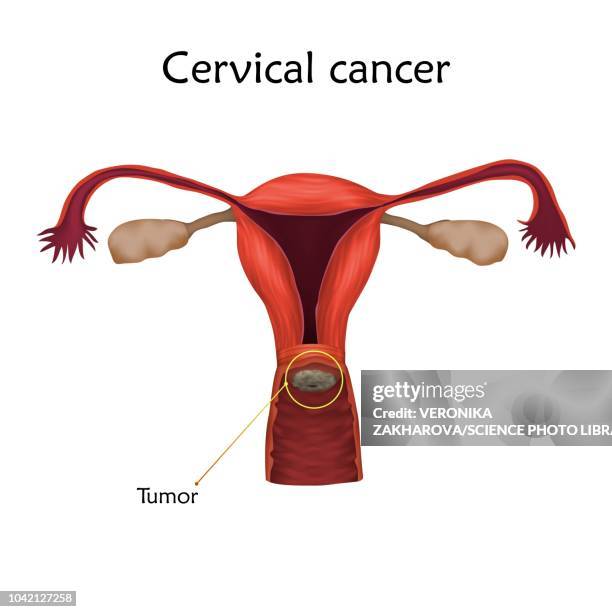 cervical cancer, illustration - gynecological examination stock illustrations