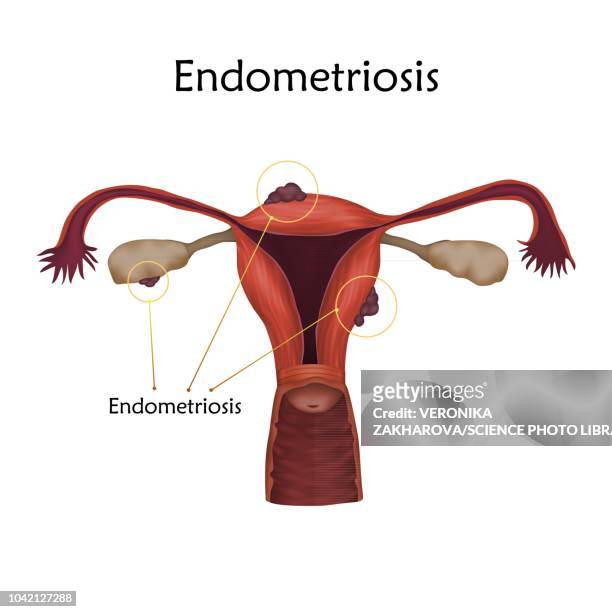 endometriosis, illustration - reproductive organ stock-grafiken, -clipart, -cartoons und -symbole