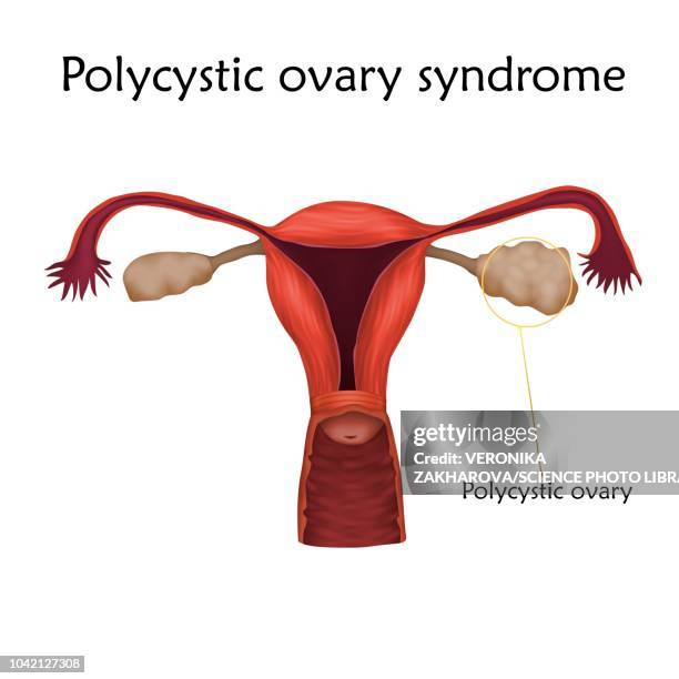 polycystic ovary syndrome, illustration - intimzone stock-grafiken, -clipart, -cartoons und -symbole