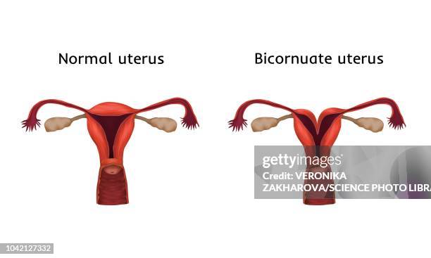 bicornuate and normal uterus, illustration - uterus stock illustrations