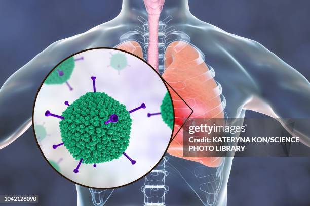 adenoviral infection of lungs, illustration - adenovirus stock-grafiken, -clipart, -cartoons und -symbole