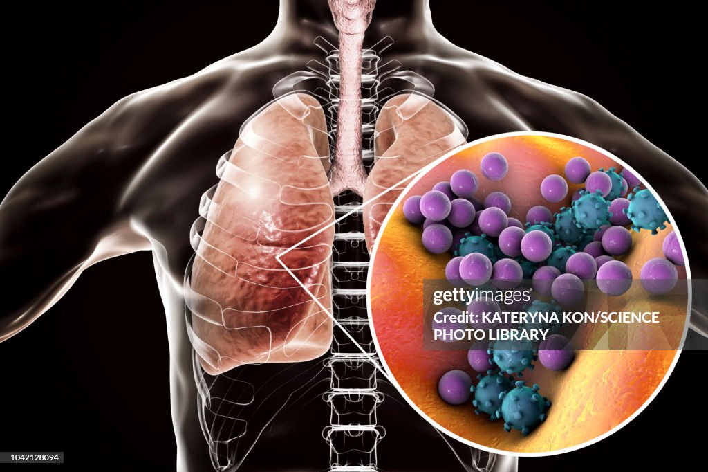 Pneumonia, conceptual illustration