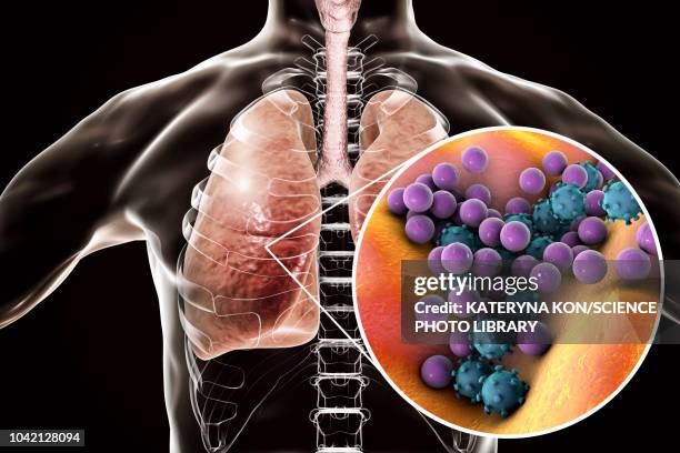 stockillustraties, clipart, cartoons en iconen met pneumonia, conceptual illustration - streptococcus pyogenes