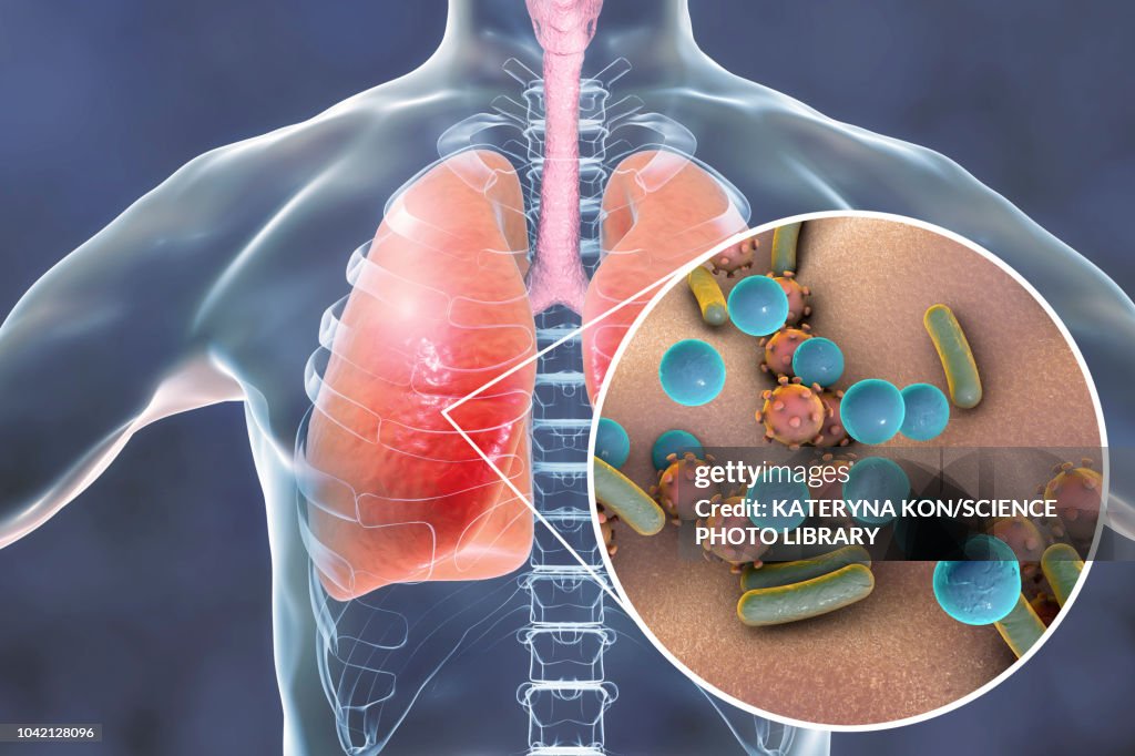 Pneumonia, conceptual illustration