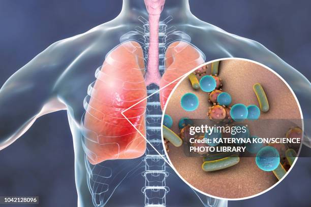 stockillustraties, clipart, cartoons en iconen met pneumonia, conceptual illustration - staphylococcus aureus