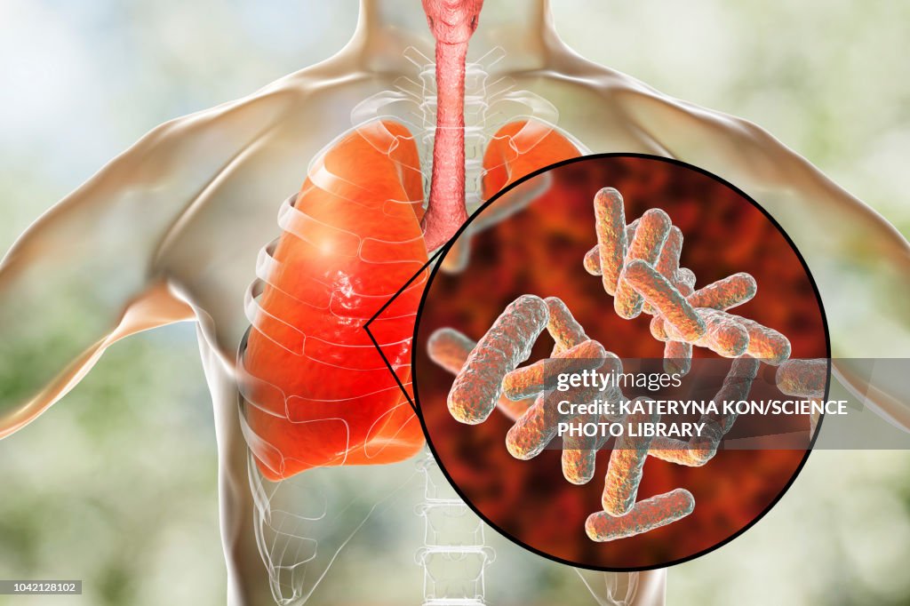 Bacterial pneumonia, conceptual illustration