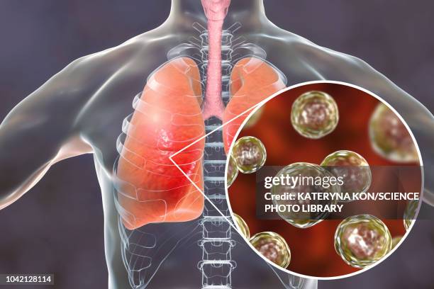 pulmonary blastomycosis, conceptual illustration - morphology stock illustrations