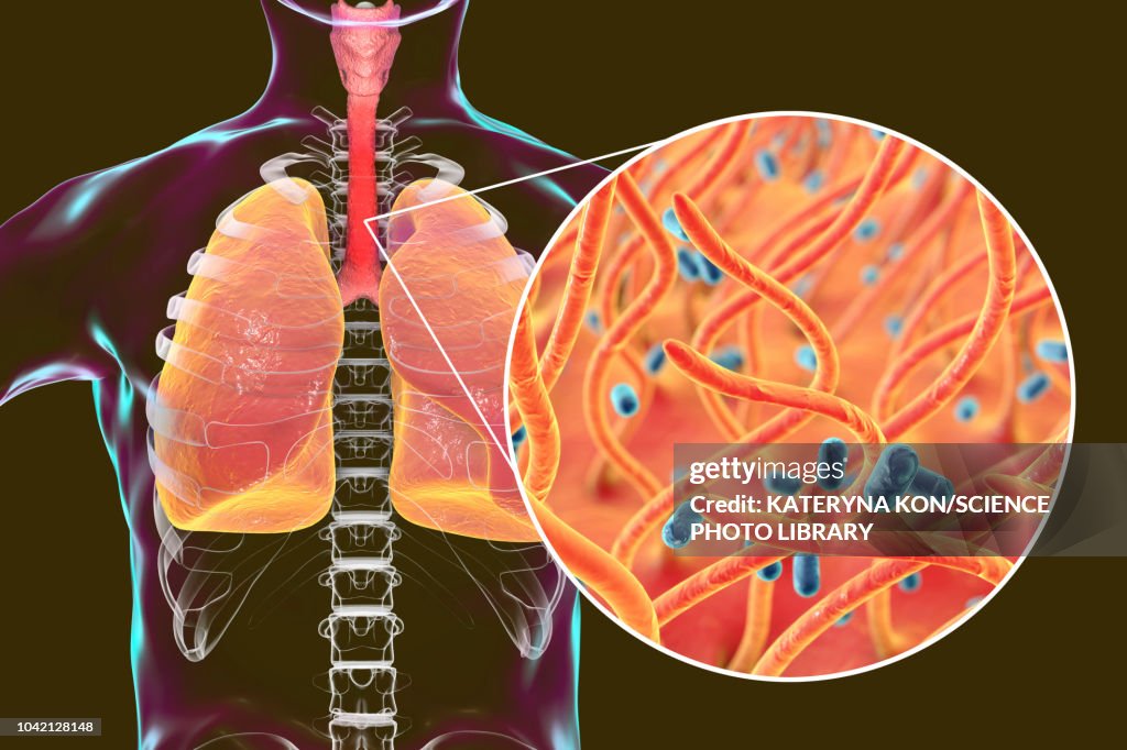 Whooping cough, conceptual illustration