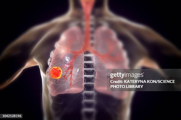 stockillustraties, clipart, cartoons en iconen met lung cancer, illustration - tumour