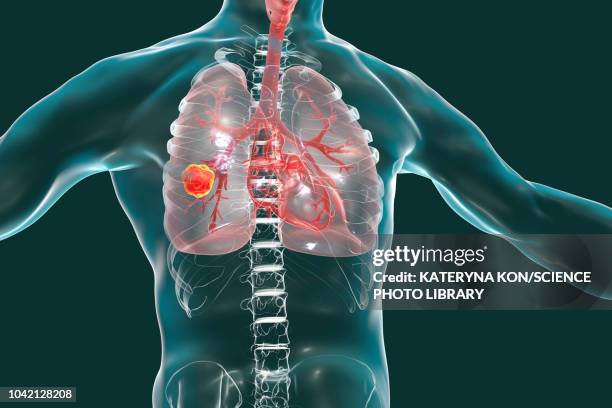 lung cancer, illustration - spread stock illustrations