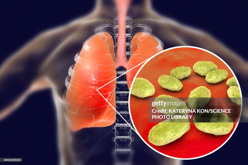Pneumonia caused by Haemophilus influenzae bacteria, illustr