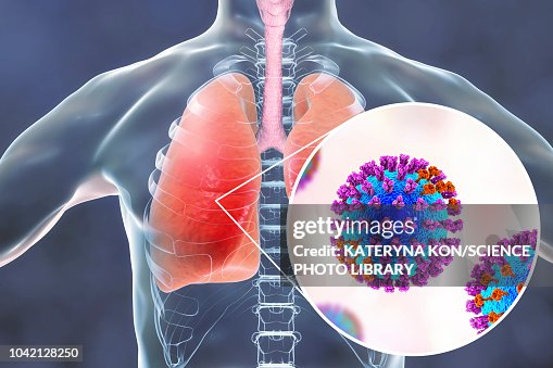 Pneumonia caused by flu, illustration Pneumonia caused by flu, illustration