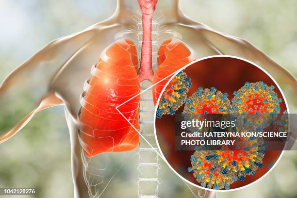 pneumonia caused by measles viruses, conceptual illustration - measles stock illustrations