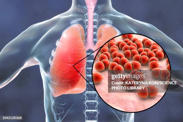 pneumonia caused by streptococcus pneumoniae bacteria, conce - lungenentzündung stock-grafiken, -clipart, -cartoons und -symbole