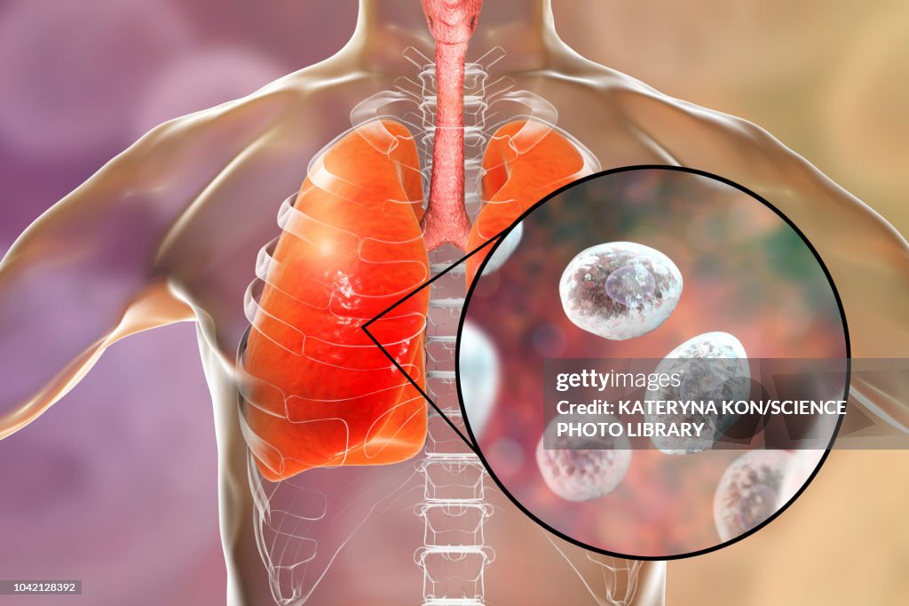 Pneumocystis pneumonia, conceptual illustration