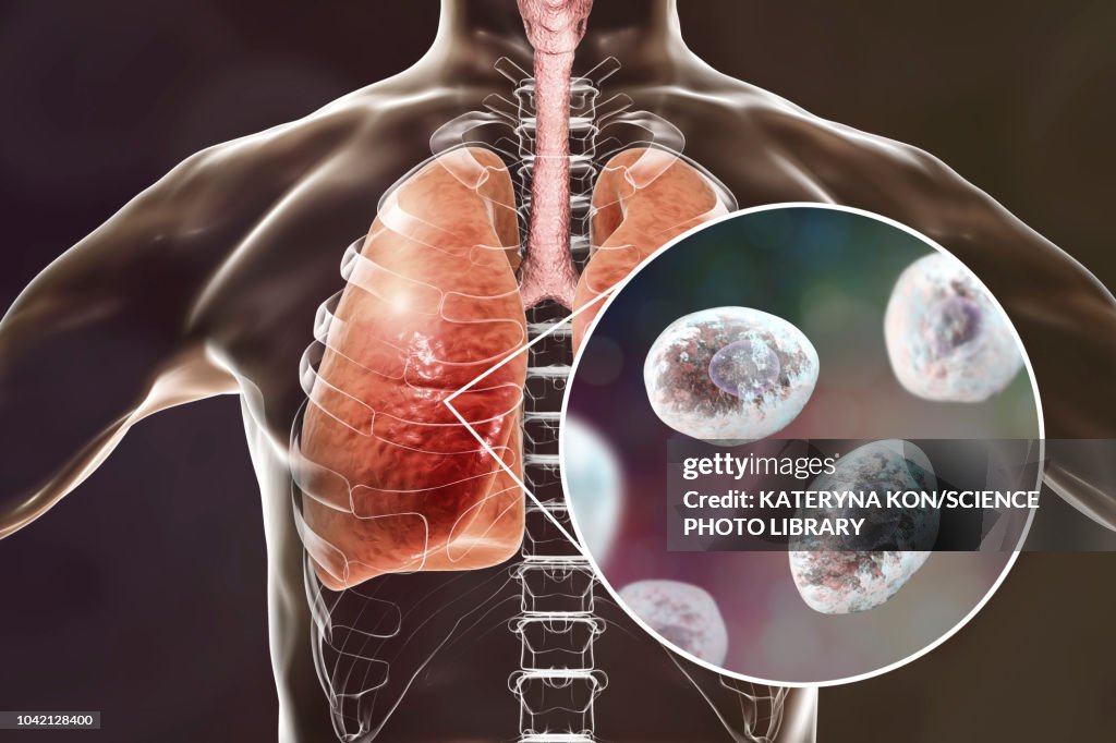 Pneumocystis pneumonia, conceptual illustration