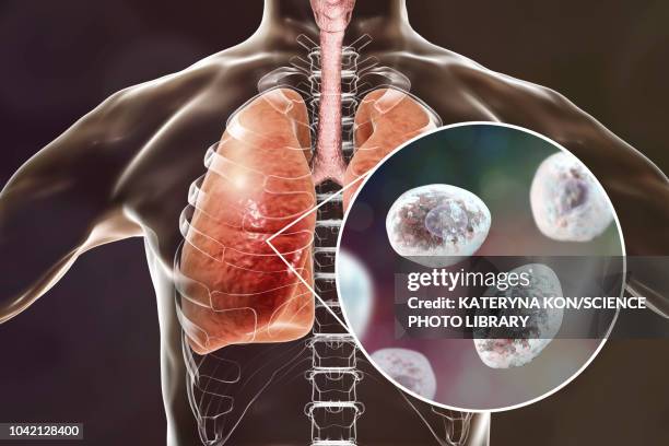 pneumocystis pneumonia, conceptual illustration - weak immune system stock illustrations