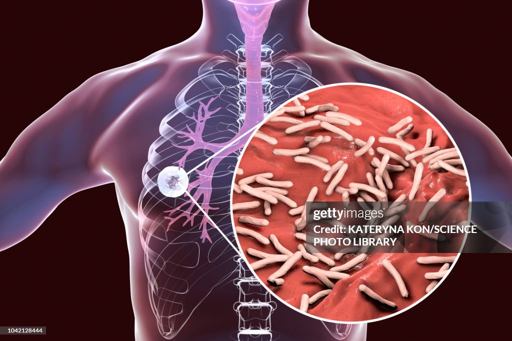 Tuberculosis Size Tuberculosis Pulmonar World TB Day: The Role Of Respiratory Viruses In
