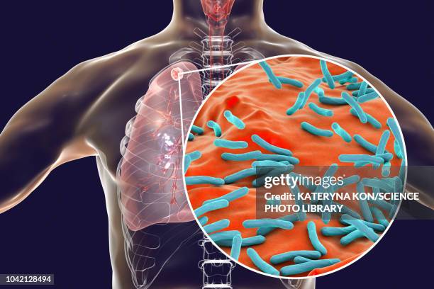 secondary tuberculosis infection, illustration - tuberculosis bacterium stock illustrations