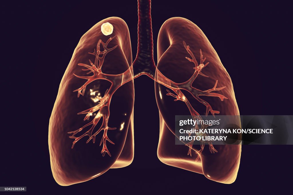 Apical nodule, secondary tuberculosis infection, illustratio