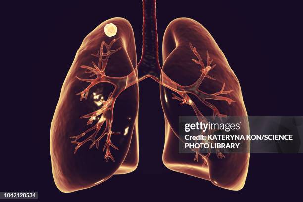 apical nodule, secondary tuberculosis infection, illustratio - infectious disease illustration stock illustrations