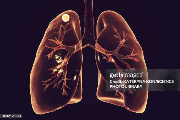 apical nodule, secondary tuberculosis infection, illustratio - tuberculosis bacterium 幅插畫檔、美工圖案、卡通及圖標