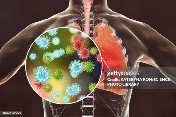 viral pneumonia, conceptual illustration - sars stock illustrations
