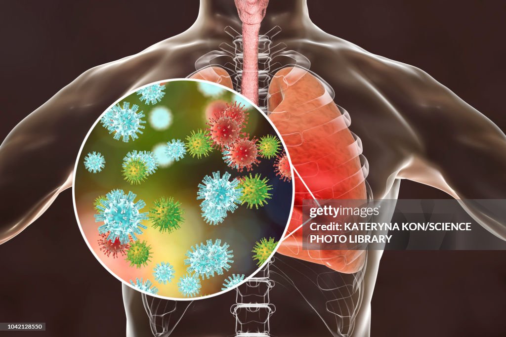 Viral pneumonia, conceptual illustration