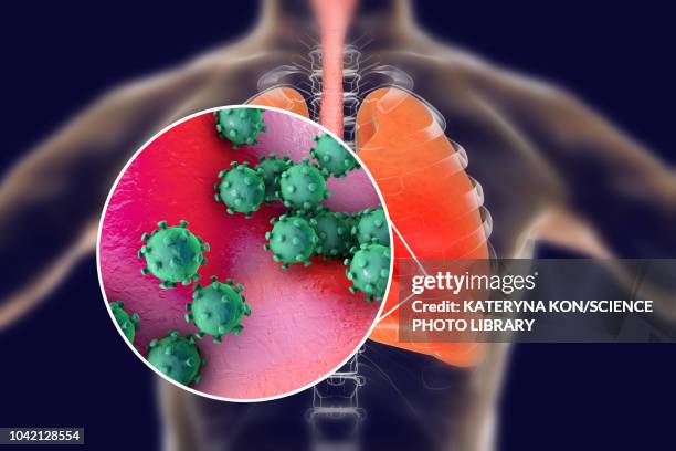 viral pneumonia, conceptual illustration - varicella zoster virus stock illustrations
