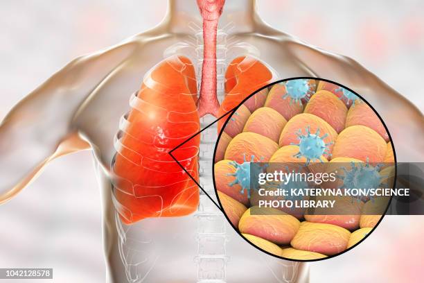 viral pneumonia, conceptual illustration - varicella zoster virus stock illustrations