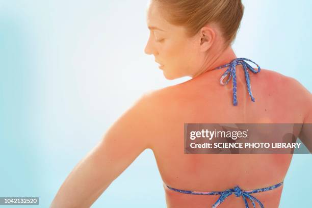 woman with sunburnt back - sunburn stock-fotos und bilder