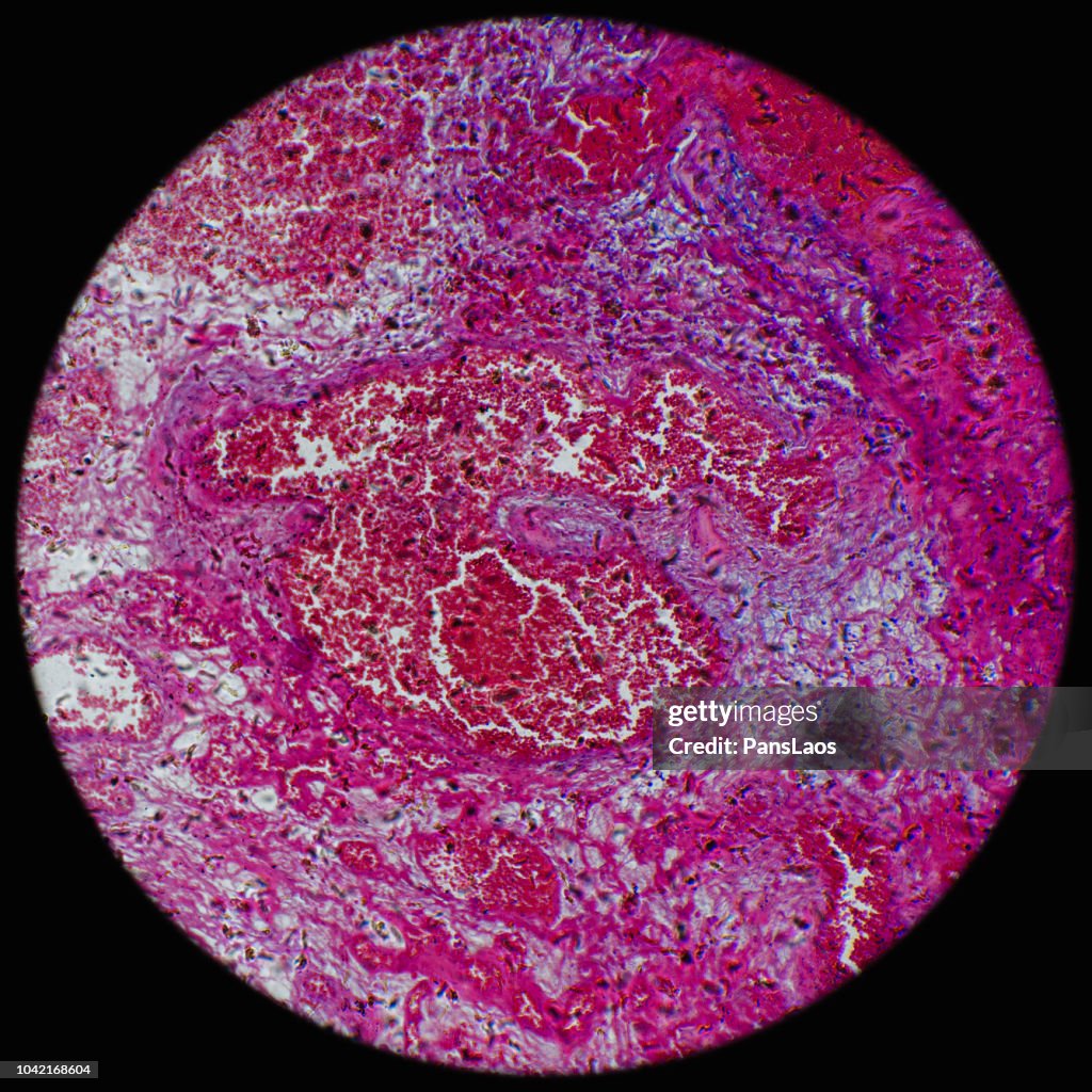 Hemangioma angioma tumor under microscope