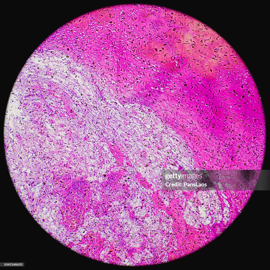 Hemangioma angioma tumor under microscope