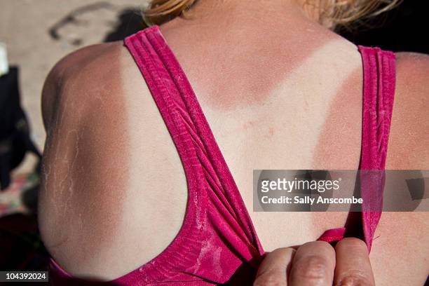 sunburn - sunburned stockfoto's en -beelden